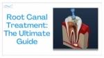 Root Canal Treatment: The Ultimate Guide